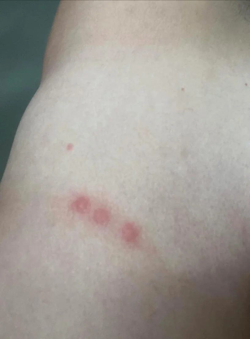Illustrative image of a forearm with a small cluster of red, raised marks